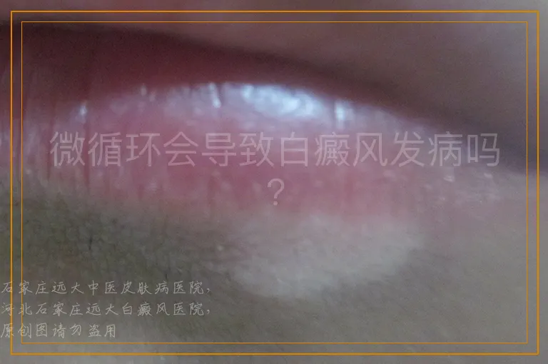 微循环会导致白癜风发病吗?