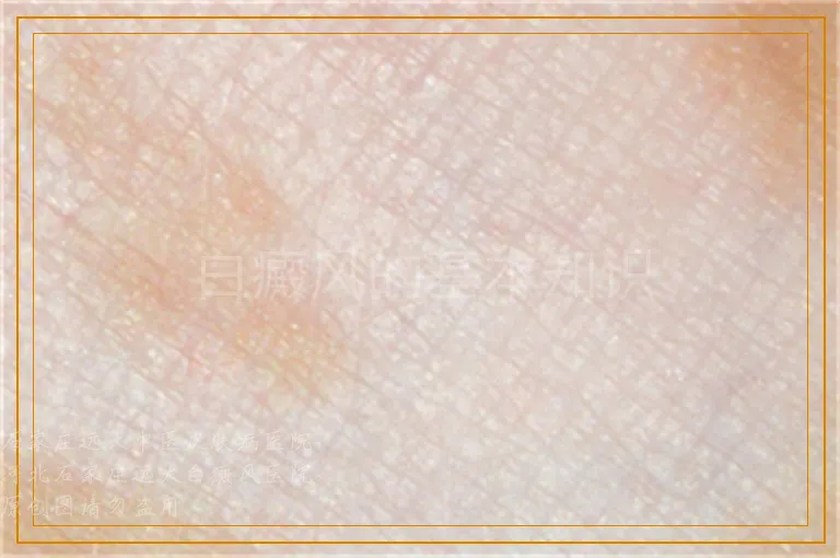 白癜风的基本知识