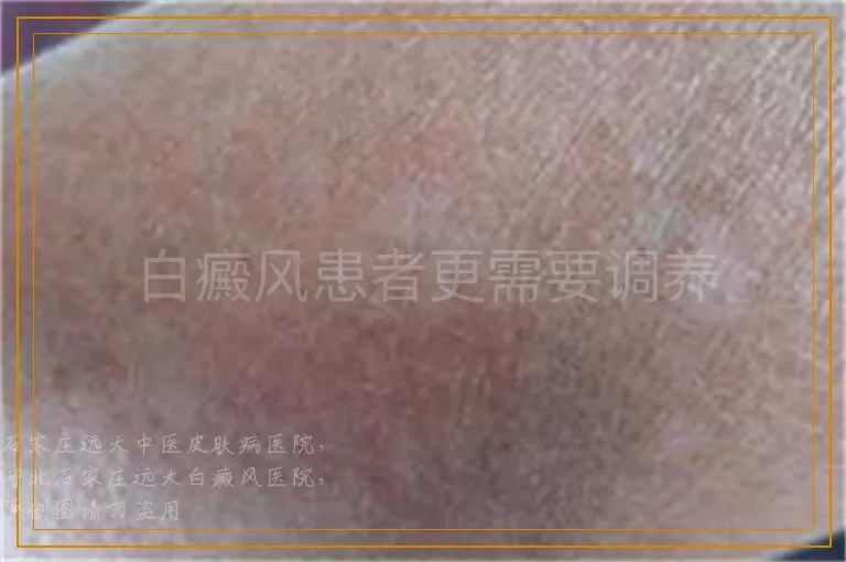 白癜风患者更需要调养
