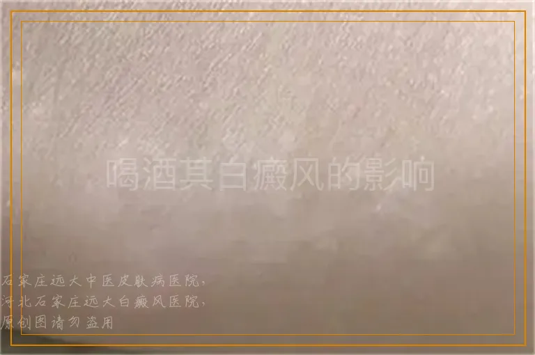 喝酒其白癜风的影响
