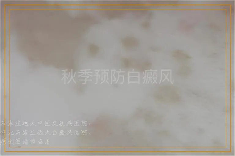 秋季预防白癜风
