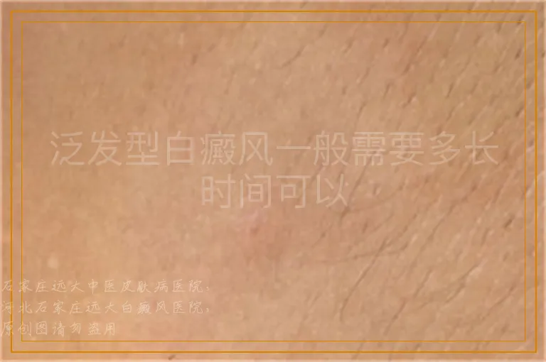 泛发型白癜风一般需要多长时间可以