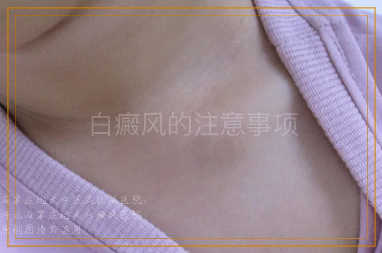 白癜风的注意事项