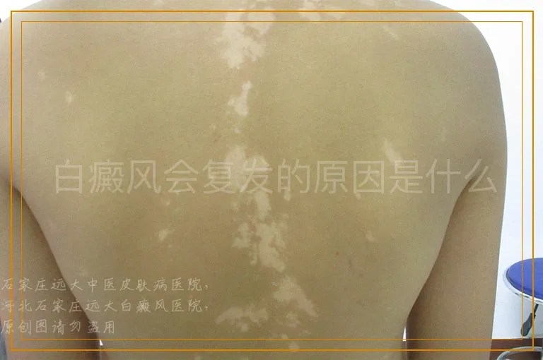 白癜风会复发的原因是什么