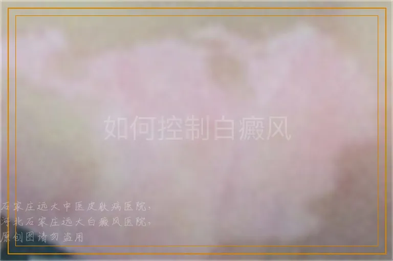 如何控制白癜风