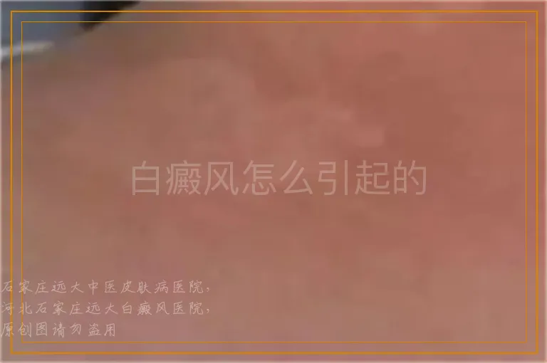 白癜风怎么引起的