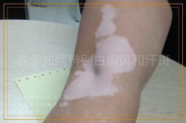 春季如何辨别白癜风和汗斑