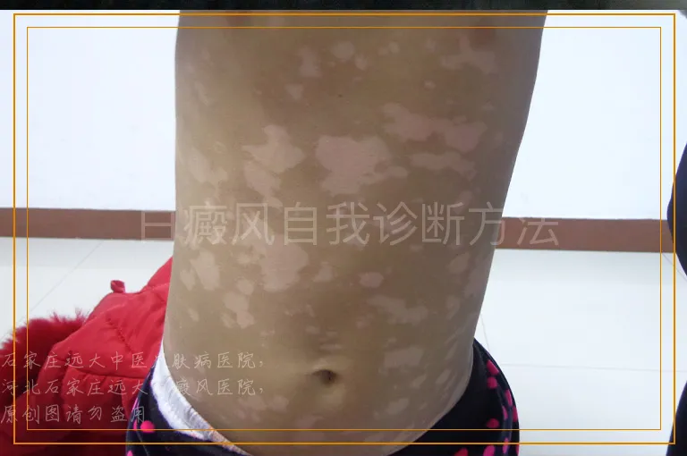 白癜风自我诊断方法