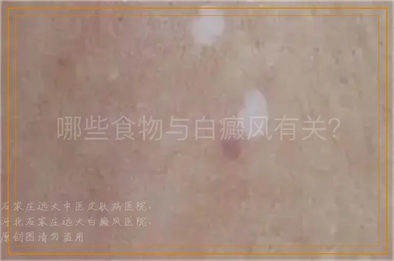 哪些食物与白癜风有关？