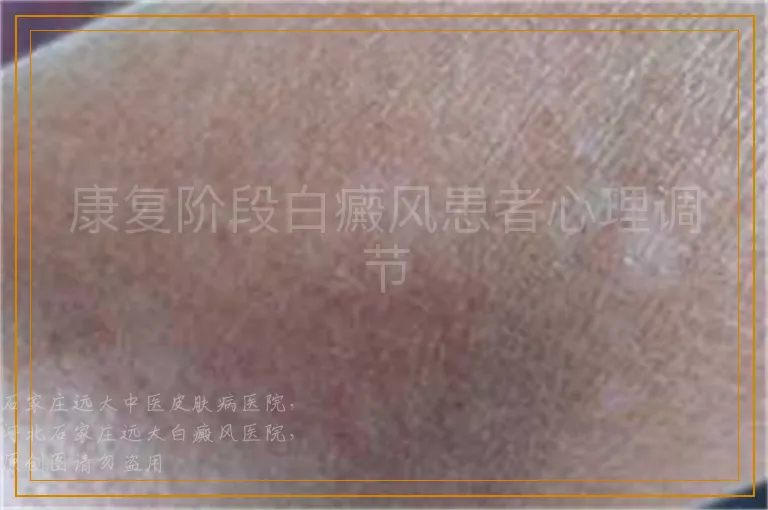 康复阶段白癜风患者心理调节