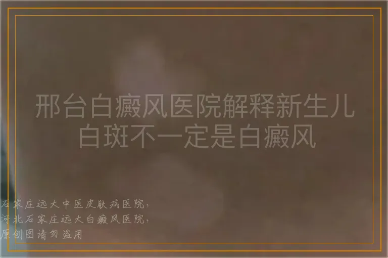邢台白癜风医院解释新生儿白斑不一定是白癜风