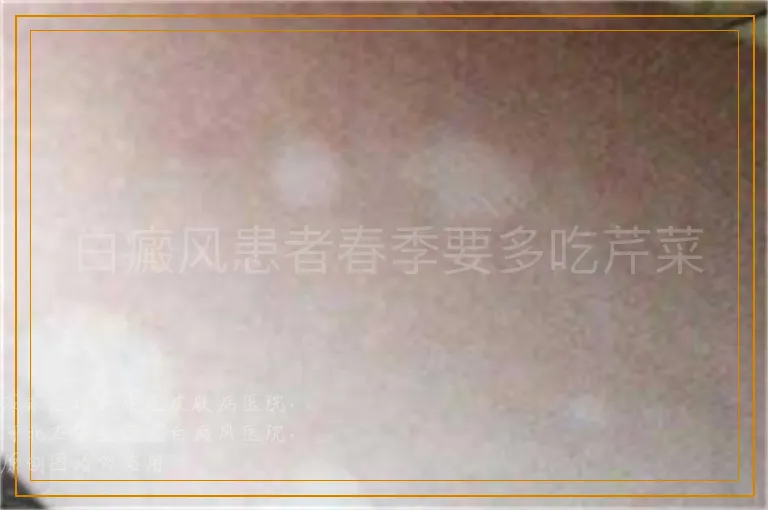 白癜风患者春季要多吃芹菜