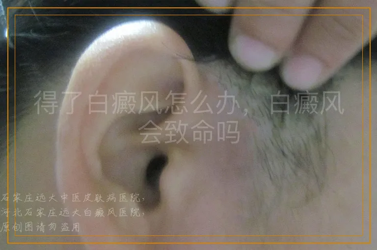 得了白癜风怎么办，白癜风会致命吗