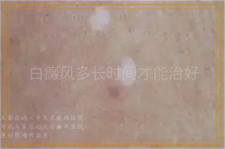 白癜风多长时间才能治好
