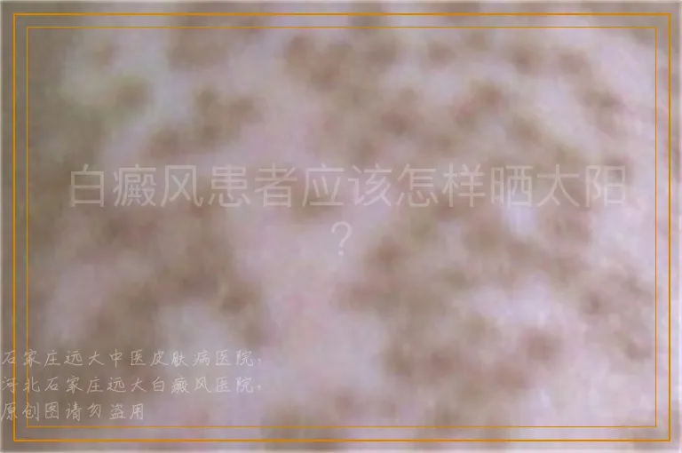 白癜风患者应该怎样晒太阳？