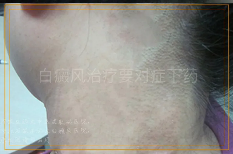 白癜风治疗要对症下药