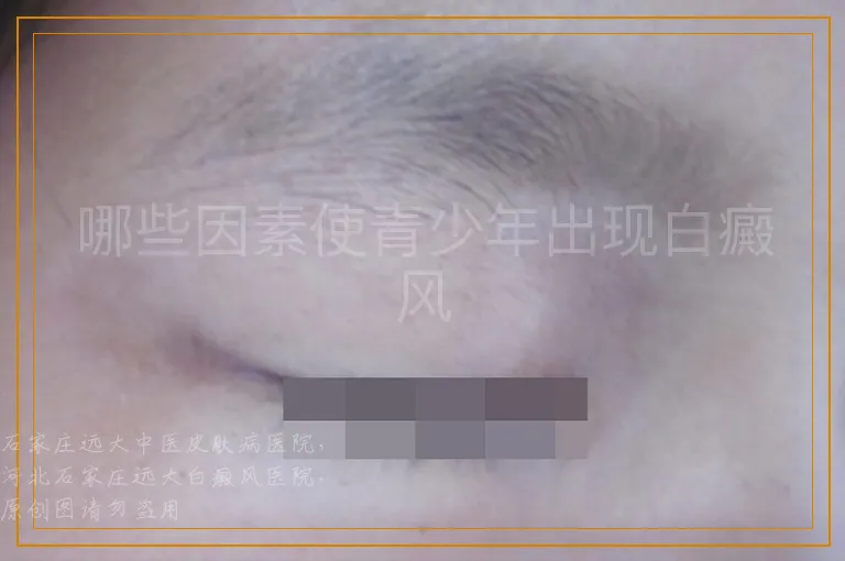 哪些因素使青少年出现白癜风
