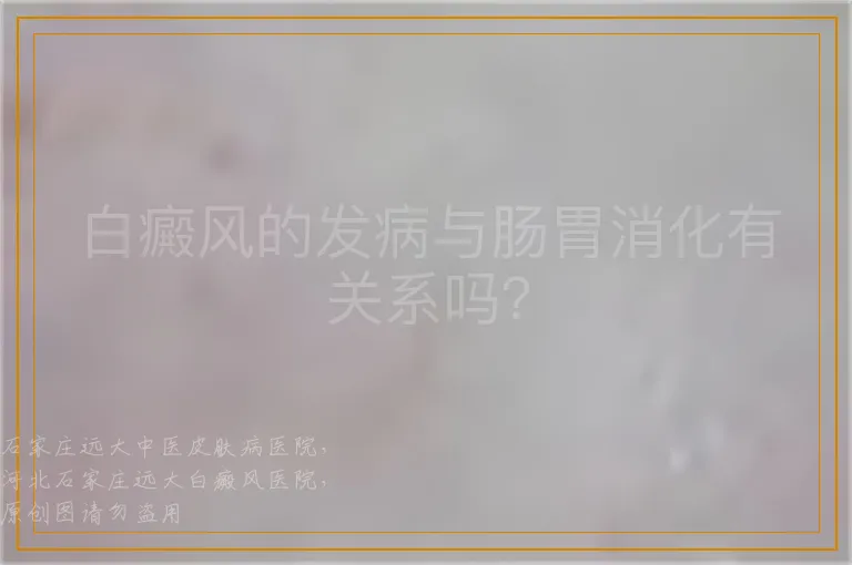 白癜风的发病与肠胃消化有关系吗？