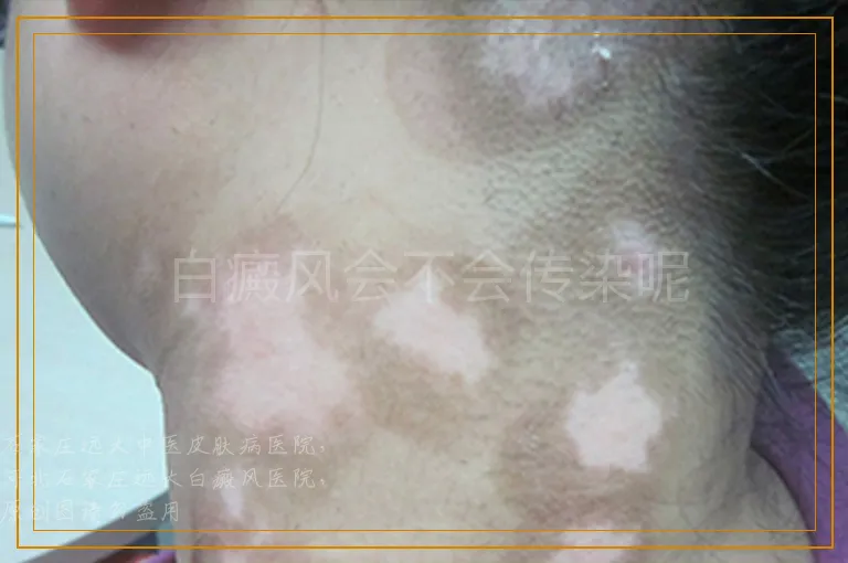 白癜风会不会传染呢