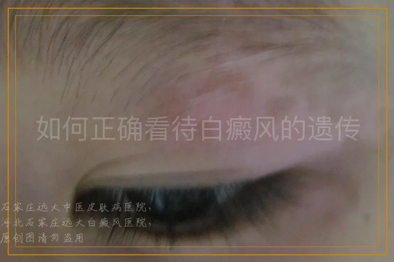 如何正确看待白癜风的遗传