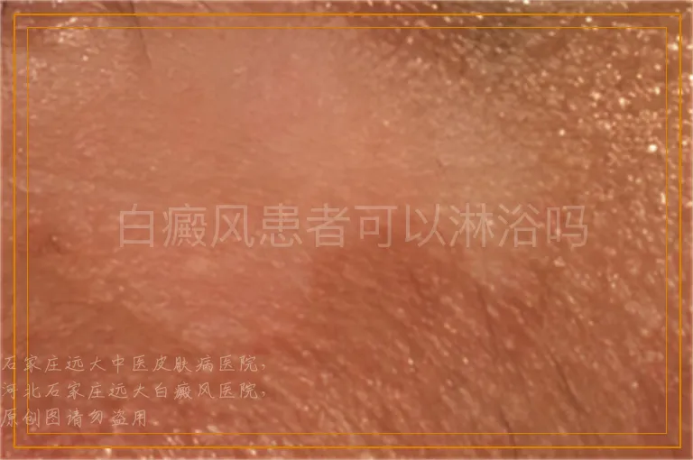 白癜风患者可以淋浴吗