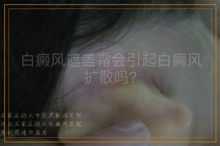 白癜风遮盖霜会引起白癜风扩散吗?