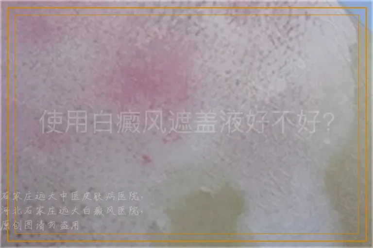 使用白癜风遮盖液好不好?