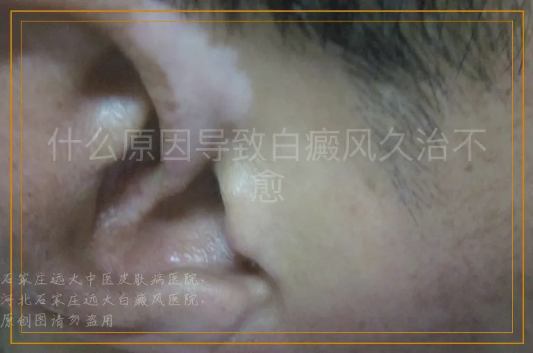 什么原因导致白癜风久治不愈