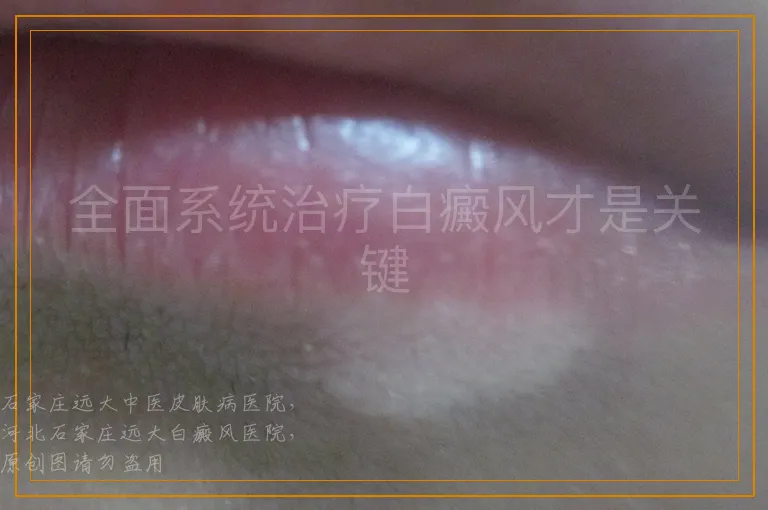 全面系统治疗白癜风才是关键