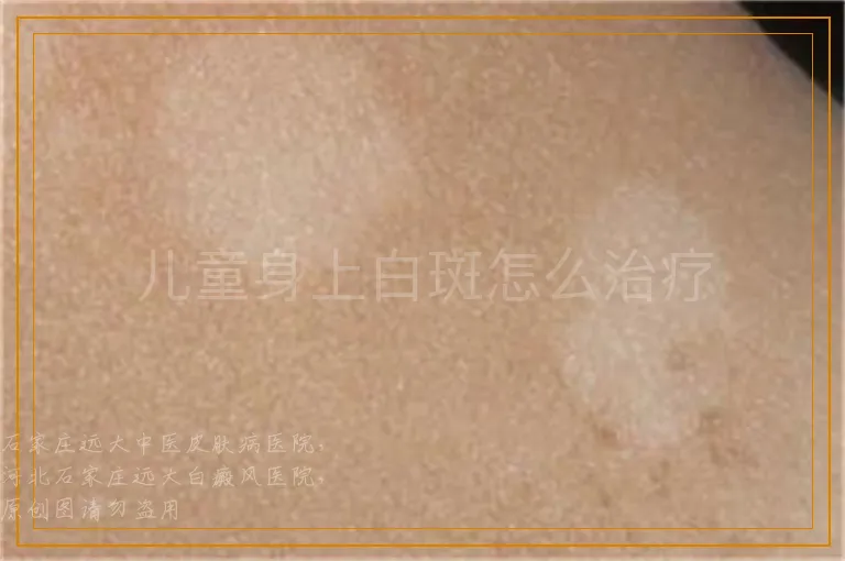 儿童身上白斑怎么治疗