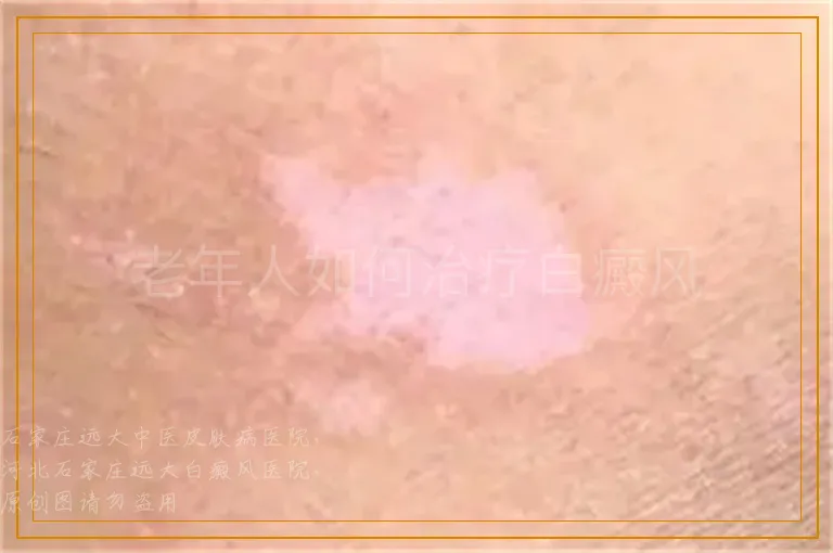 老年人如何治疗白癜风