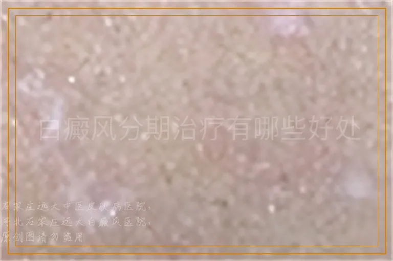 白癜风分期治疗有哪些好处