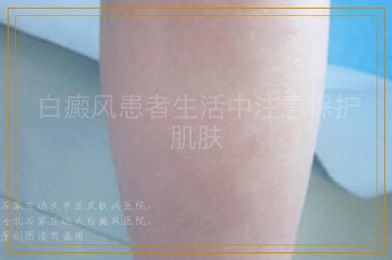 白癜风患者生活中注意保护肌肤