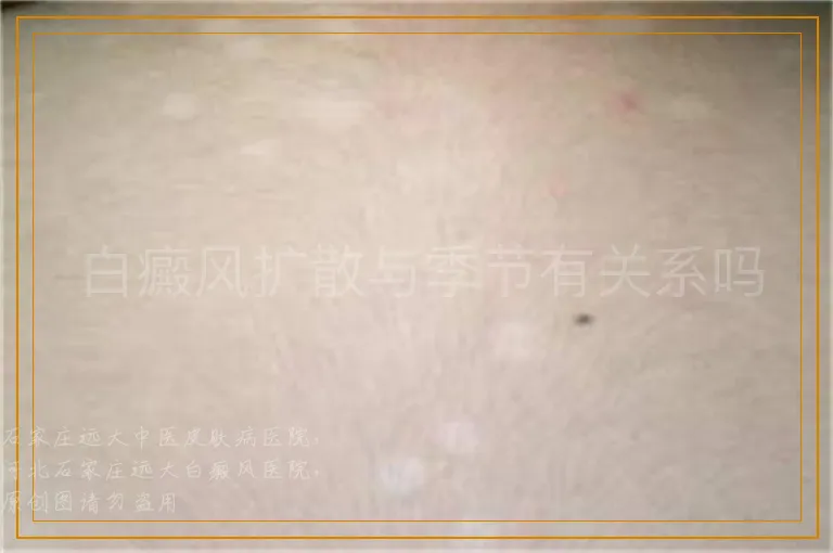 白癜风扩散与季节有关系吗
