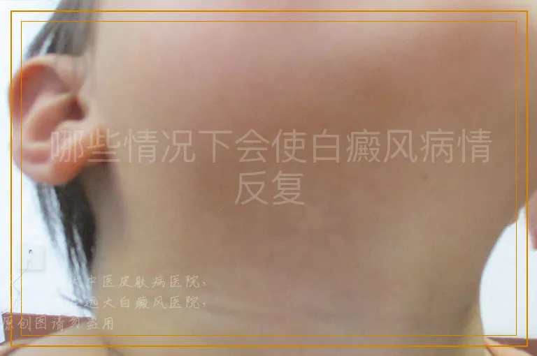 哪些情况下会使白癜风病情反复