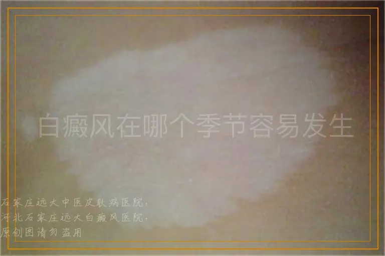 白癜风在哪个季节容易发生