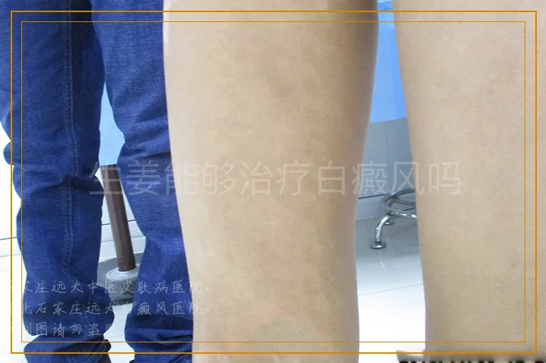 生姜能够治疗白癜风吗