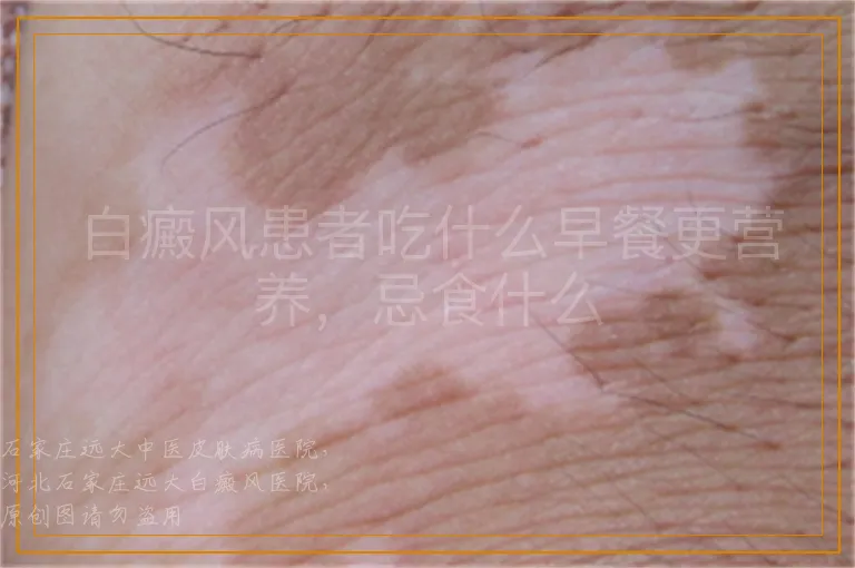 白癜风患者吃什么早餐更营养，忌食什么