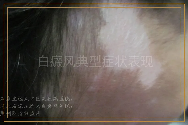 白癜风典型症状表现