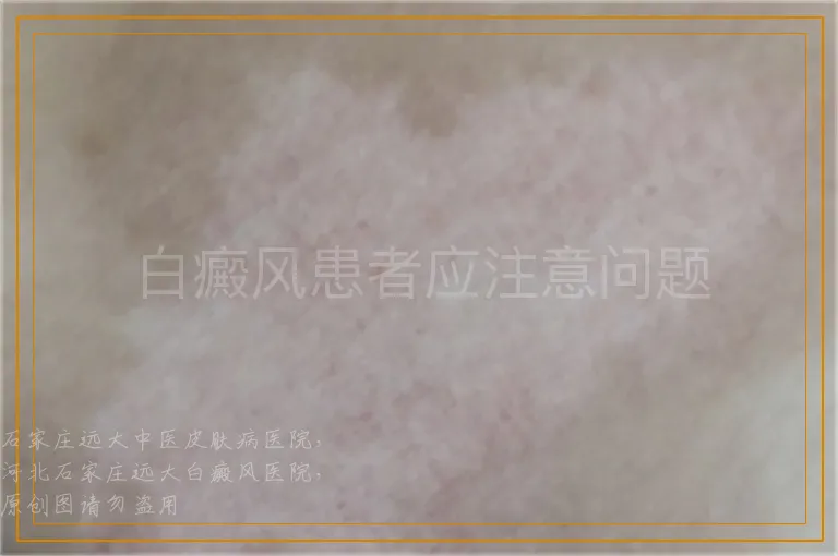 白癜风患者应注意问题