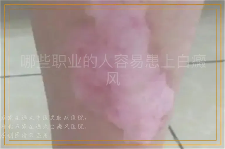 哪些职业的人容易患上白癜风