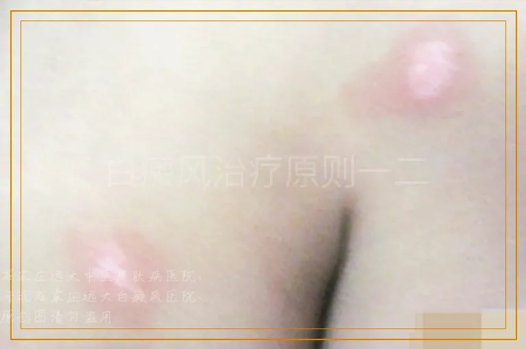 白癜风治疗原则一二
