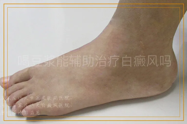 喝豆浆能辅助治疗白癜风吗