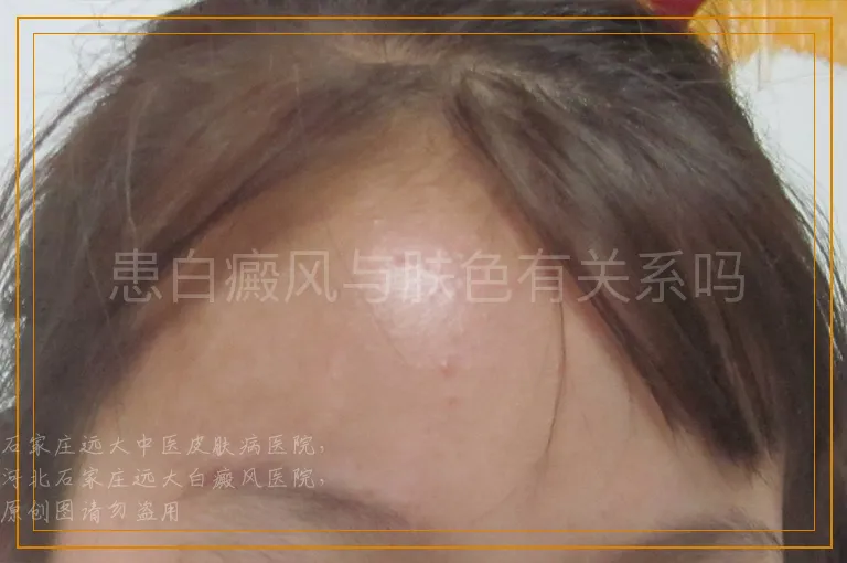 患白癜风与肤色有关系吗