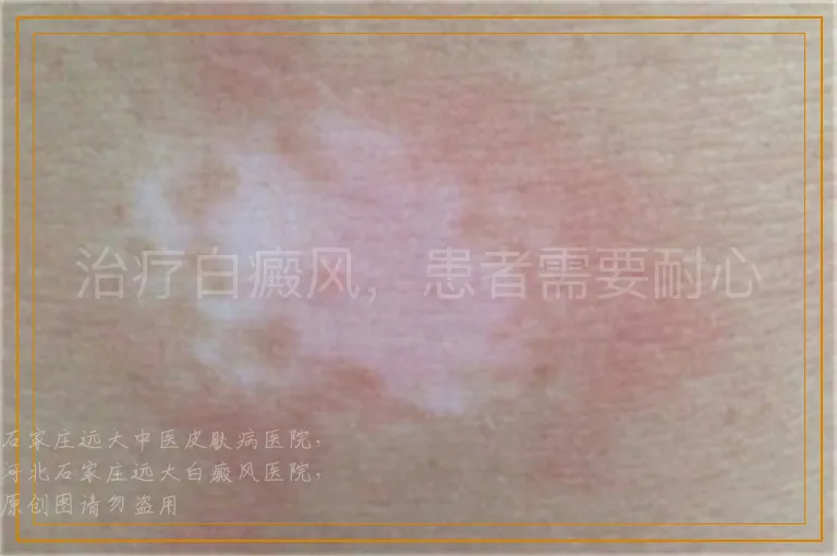 治疗白癜风，患者需要耐心