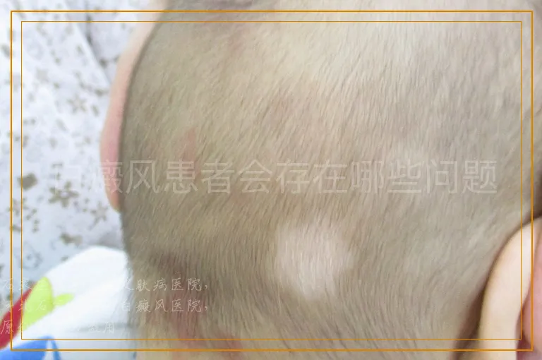 白癜风患者会存在哪些问题