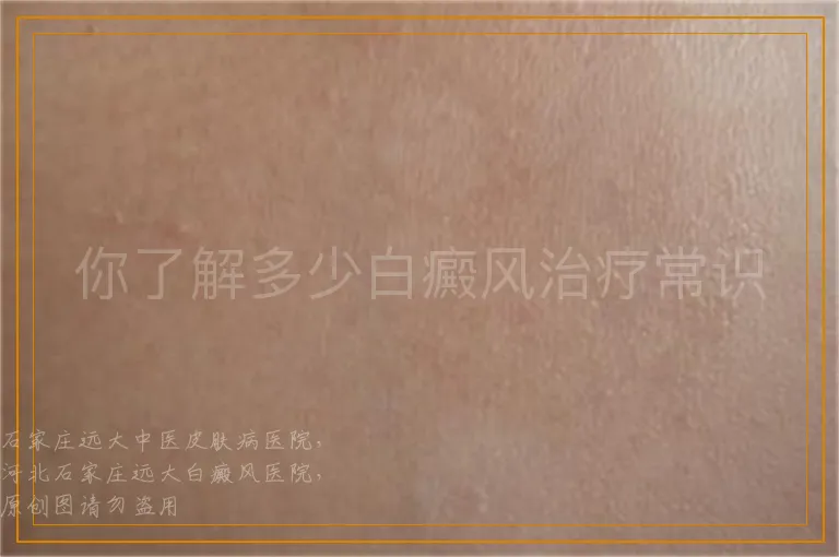 你了解多少白癜风治疗常识