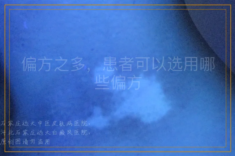 偏方之多，患者可以选用哪些偏方