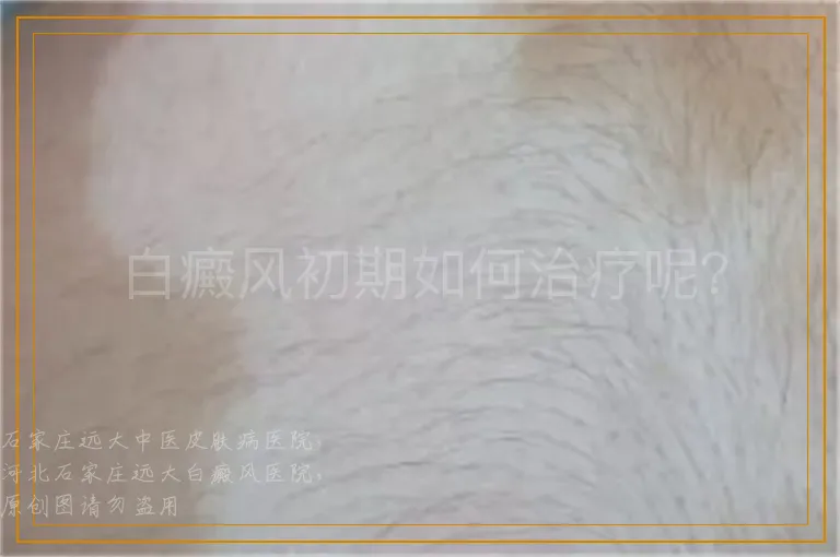 白癜风初期如何治疗呢？