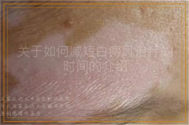 关于如何减短白癜风治疗的时间的介绍